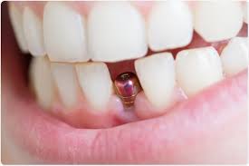ایمپلنت دندان جلو (2)