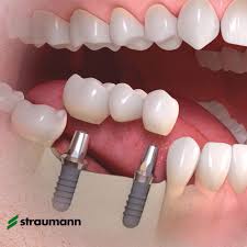 ایمپلنت دندان کنار هم (1)