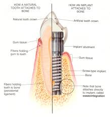 کلینیک ایمپلنت دندان                                
